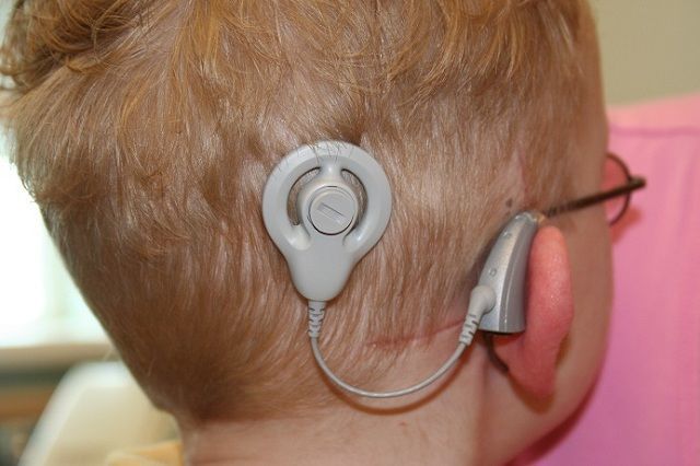 La neuroprótesis sonora permite que niños con sordera profunda, de origen coclear, desarrollen el lenguaje oral.